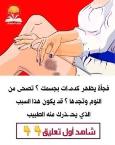 5 أسباب تؤدي لظهور الكدمات بجسمك.. واحد منها خطير جداً