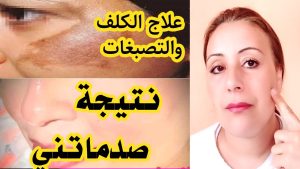 وصفه علاج الكلف والبقع الداكنه في البشره