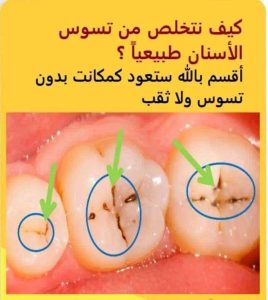 ازاله تسوس الأسنان