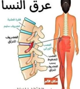 اسباب عرق النسا الشائعة أبرزها الانزلاق الغضروفى